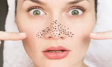 Alami Kulit Berkomedo? Ini Rekomendasi Facial Wash yang Cocok Kamu Gunakan