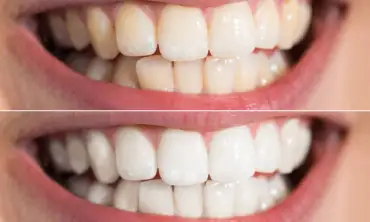 5 Cara Memutihkan Gigi dengan Bahan-Bahan yang Bisa Ditemukan di Sekitar Anda
