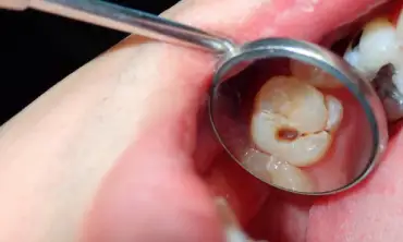 Benarkah Gigi Berlubang Bisa Mempengaruhi Kesehatan Gigi dan Mulut? Begini Penjelasannya