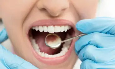 Pembentukan Karang Gigi pada Pasien Kanker, Begini Tantangan dan Solusi yang Harus Dihadapi