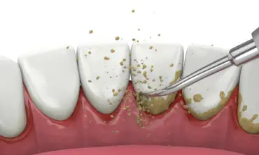 9 Alasan Pentingnya Deteksi Dini Masalah Karang Gigi, Lengkap dengan Cara Melakukannya