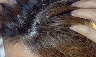 Awas! 5 Kebiasaan Buruk Ini Bisa Menyebabkan Masalah Kutu Rambut