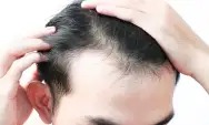 Anti Botak! 10 Tips Perawatan Khusus Rambut Rontok untuk Cegah Kebotakan pada Pria